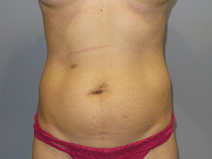Liposuction before photo
