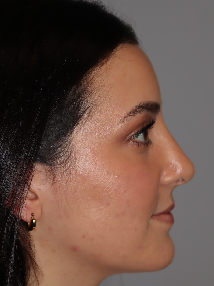 Rhinoplasty result at Grover Surgical Arts