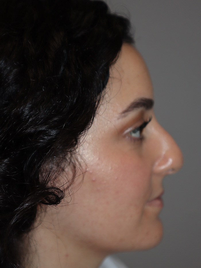 Rhinoplasty before photo