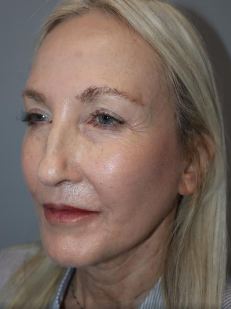 Facelift result at Grover Surgical Arts