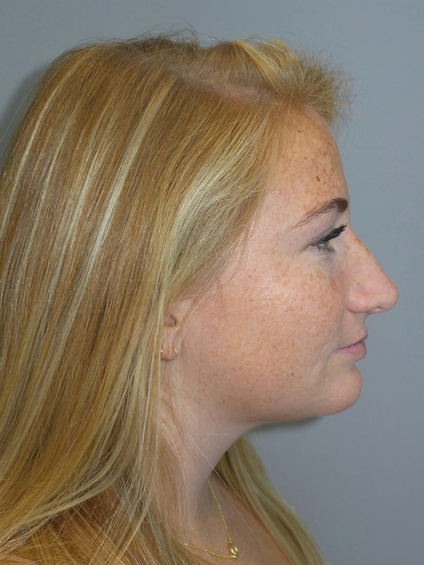Rhinoplasty result at Grover Surgical Arts