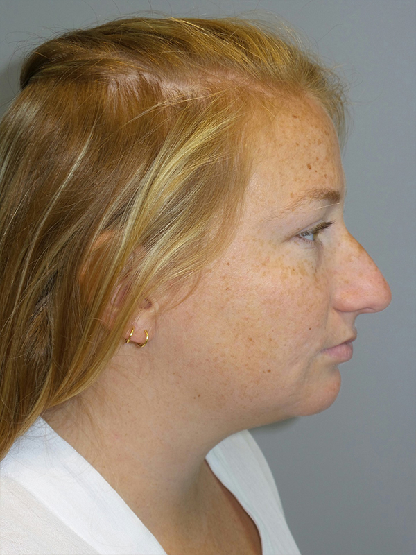 Rhinoplasty before photo