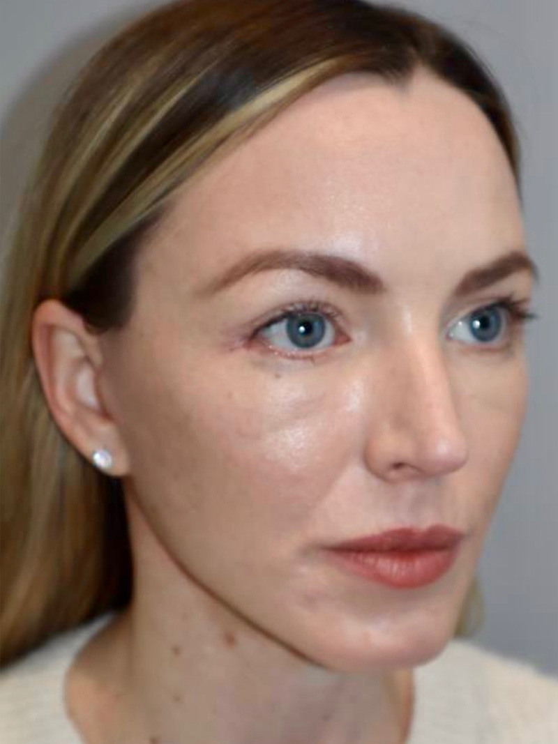 Facelift result at Grover Surgical Arts