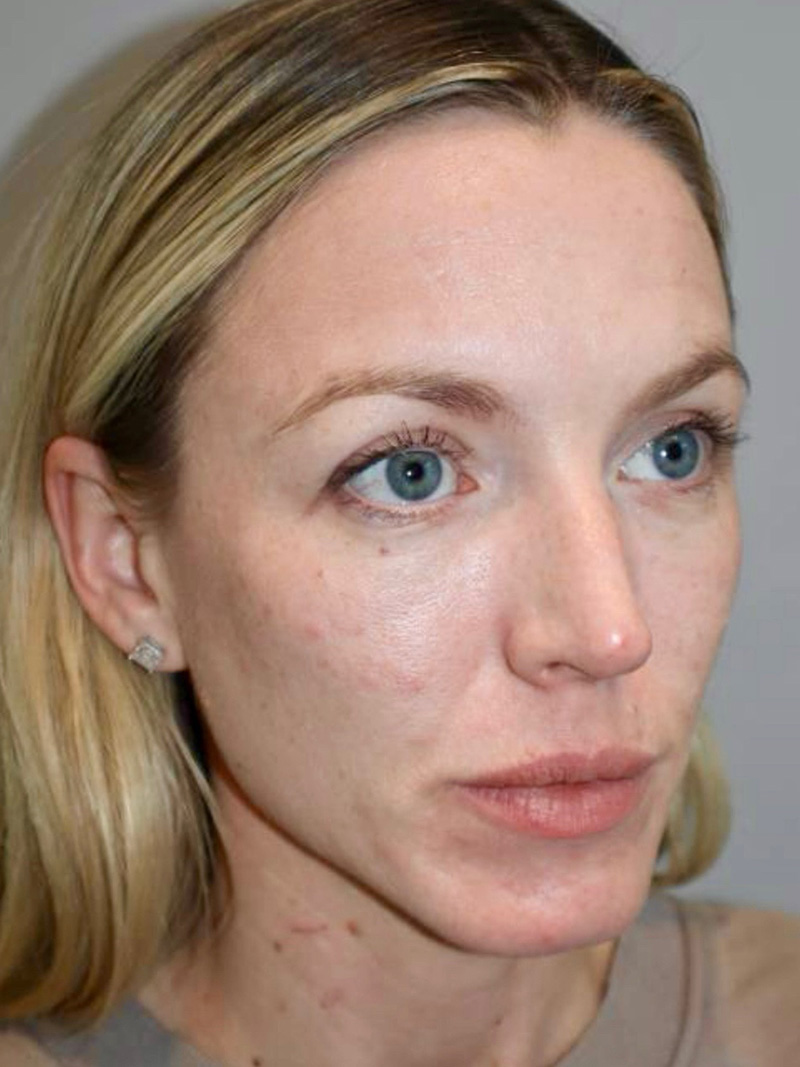 Facelift before photo
