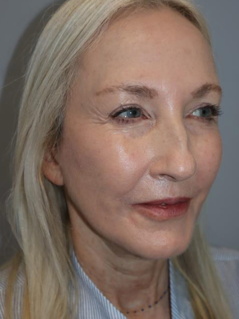 Facelift result at Grover Surgical Arts