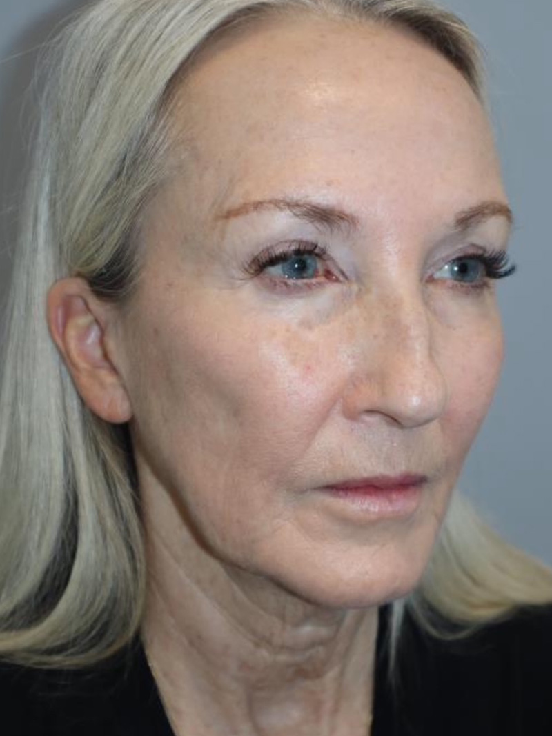 Facelift before photo