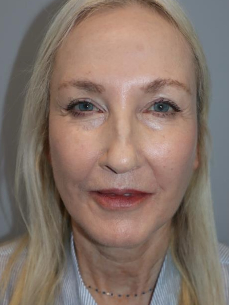 Facelift result at Grover Surgical Arts