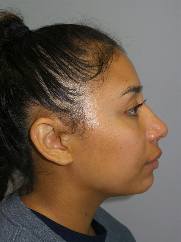 Rhinoplasty result at Grover Surgical Arts