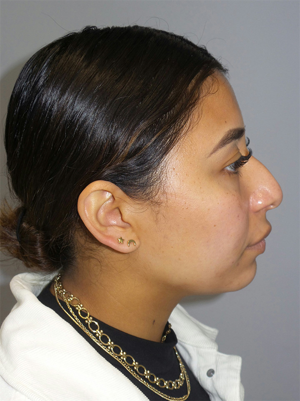 Rhinoplasty before photo