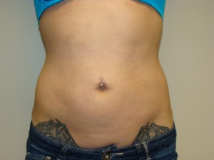 Liposuction result at Grover Surgical Arts