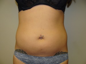 Liposuction before photo