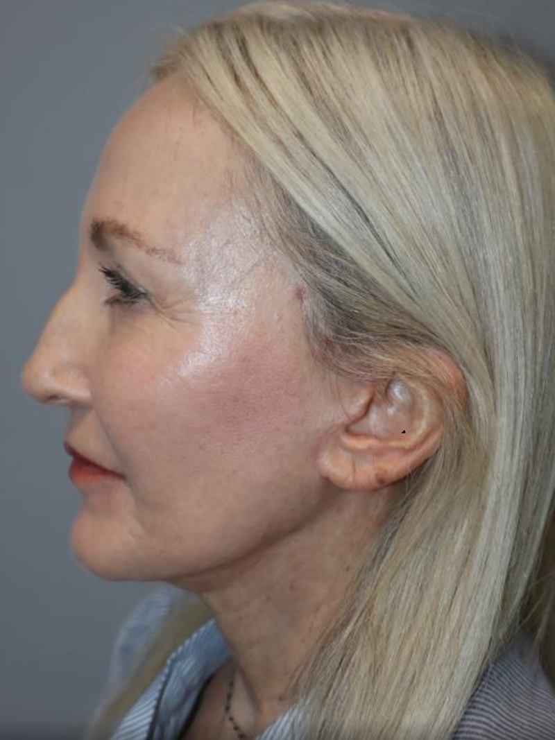 Facelift result at Grover Surgical Arts