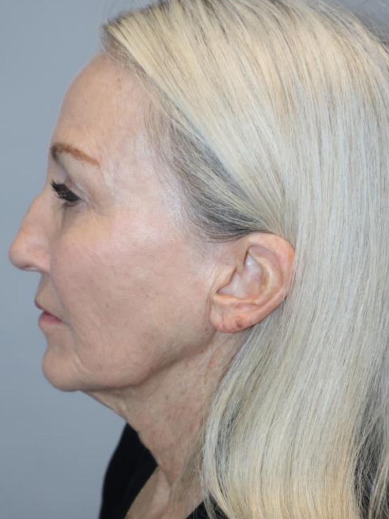 Facelift before photo