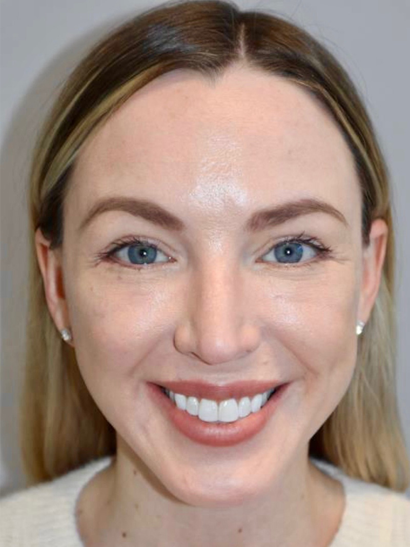 Facelift result at Grover Surgical Arts