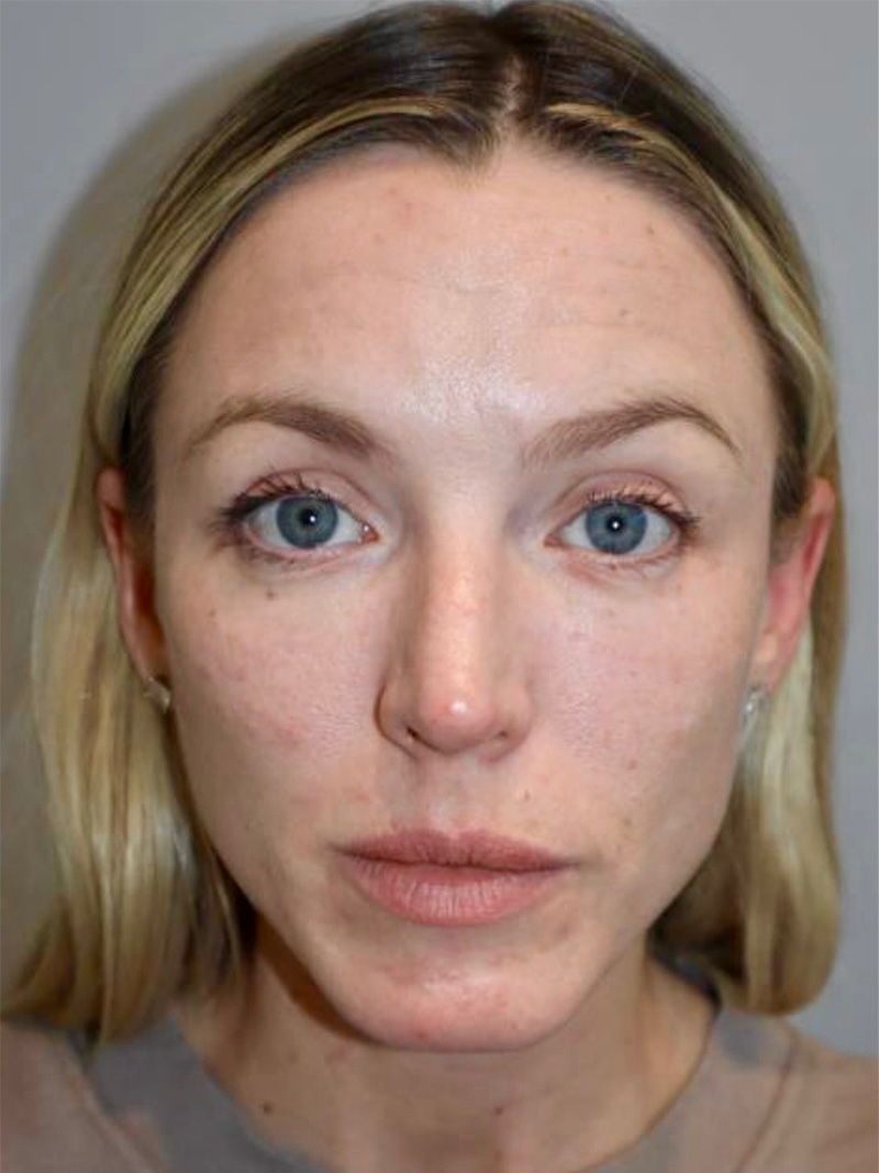 Facelift before photo