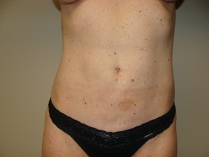 Liposuction result at Grover Surgical Arts