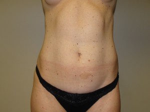 Liposuction before photo