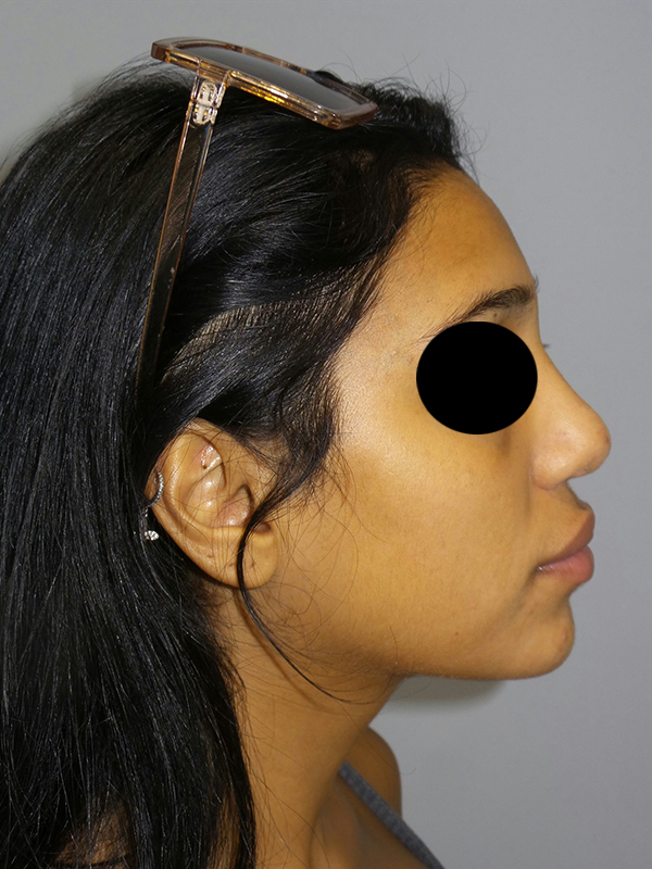 Rhinoplasty result at Grover Surgical Arts
