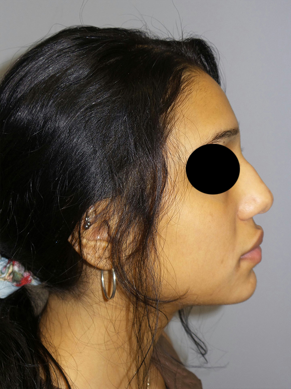 Rhinoplasty before photo