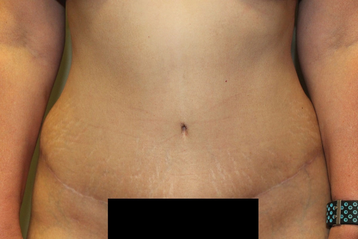A result from Boulder Valley Plastic Surgery