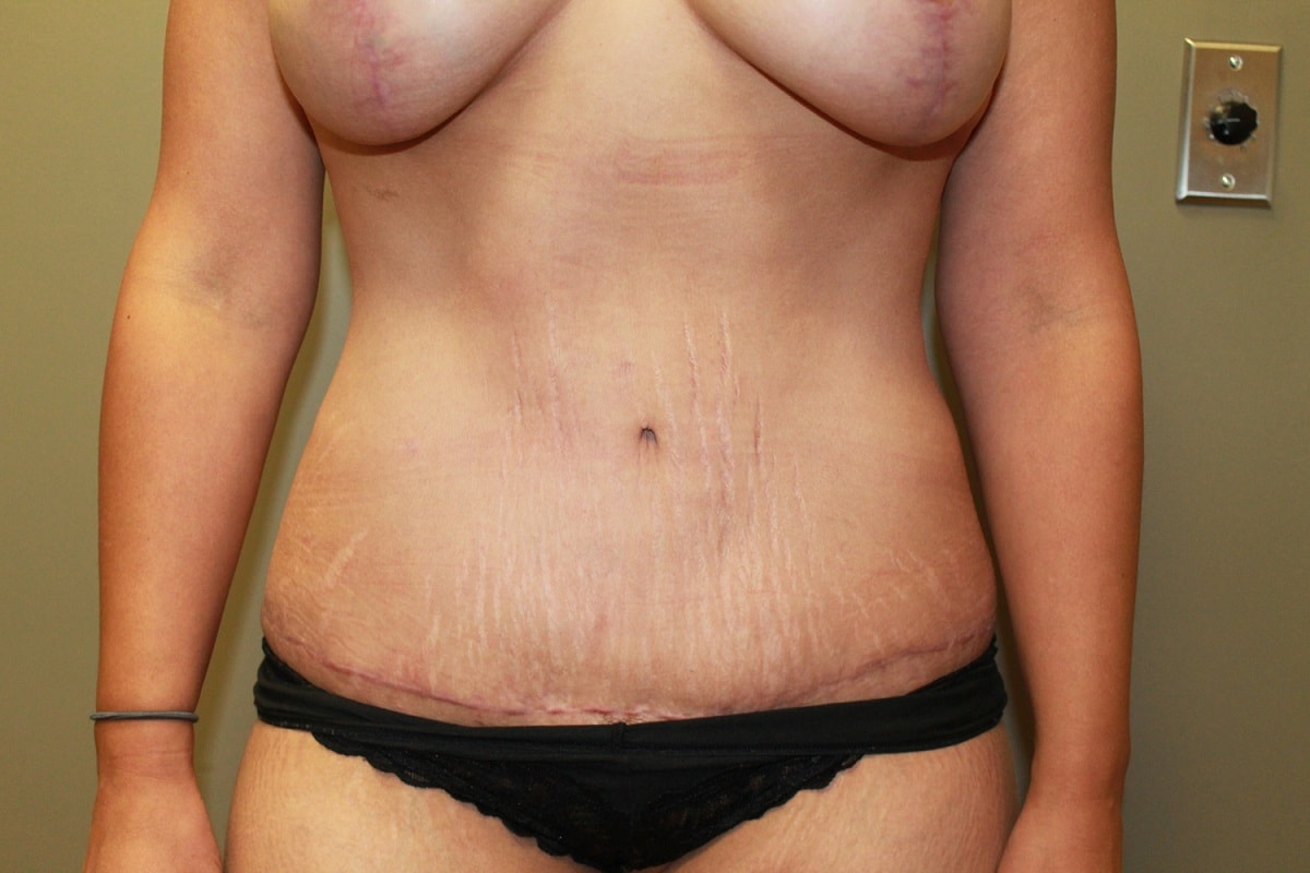 A result from Boulder Valley Plastic Surgery