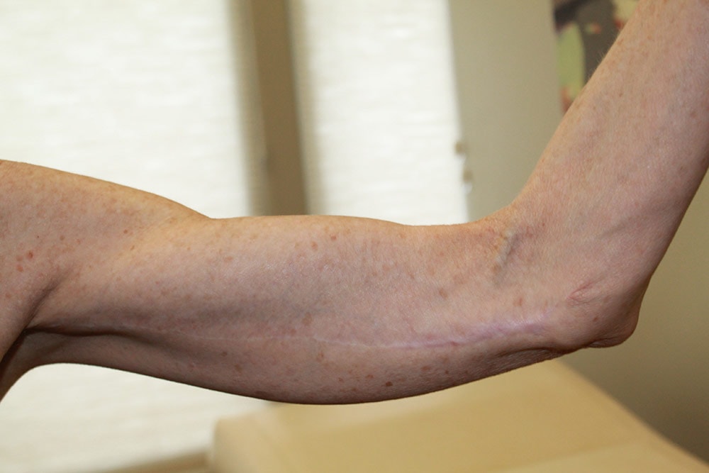 A result from Boulder Valley Plastic Surgery