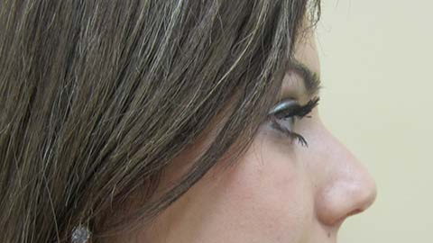 A result from The Pennsylvania Centre for Plastic Surgery: Scott A. Brenman, M.D., F.A.C.S.
