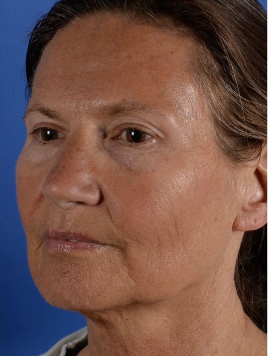 A result from Colorado Facial Plastic Surgery
