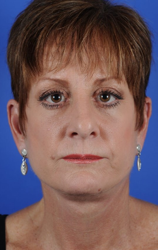 A result from Colorado Facial Plastic Surgery