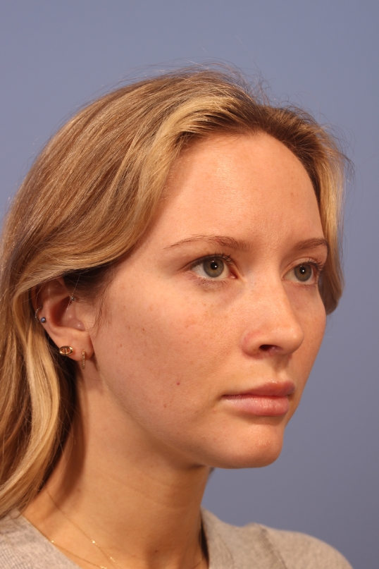 A result from Dauwe Plastic Surgery