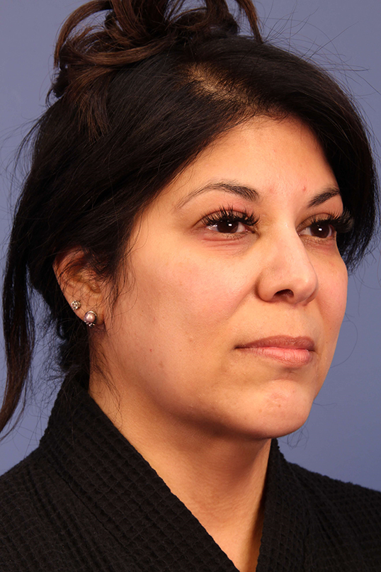 A result from Dauwe Plastic Surgery