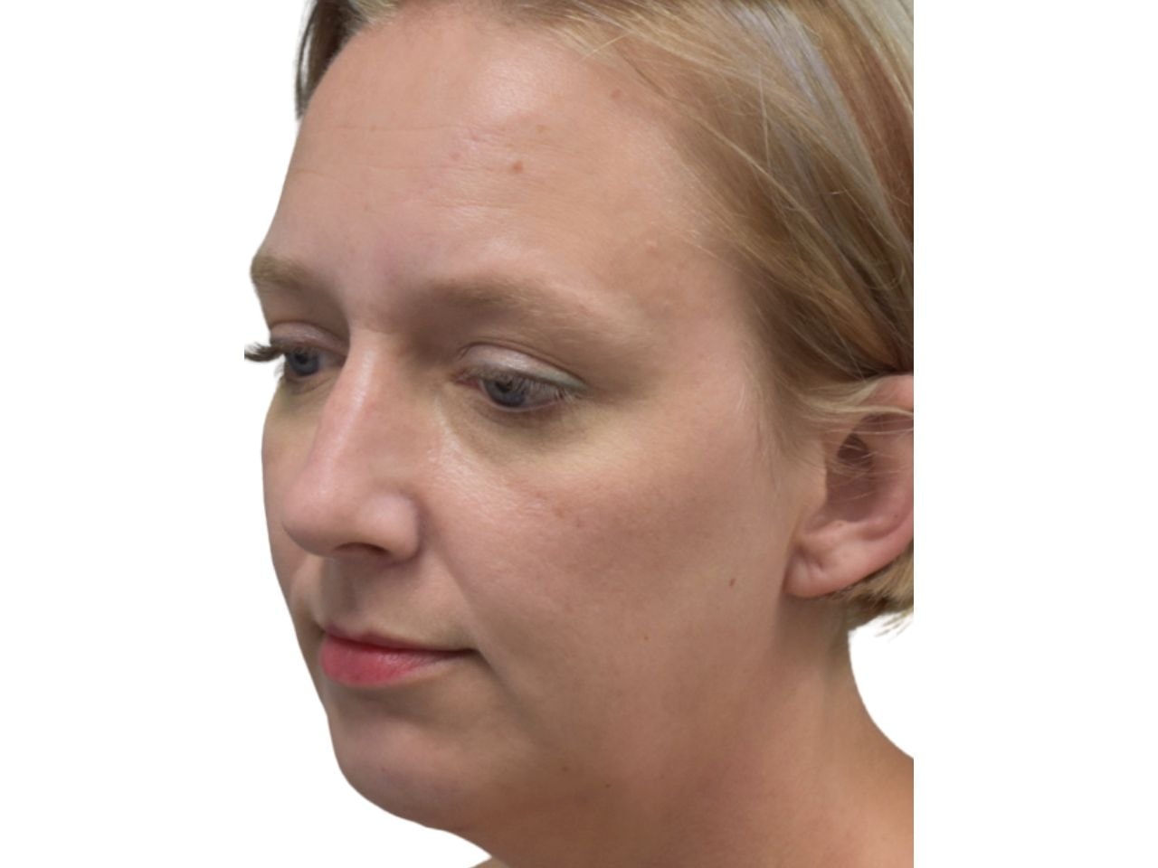 A result from Ava Bello Plastic Surgery