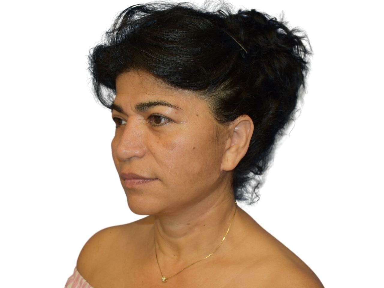 A result from Ava Bello Plastic Surgery