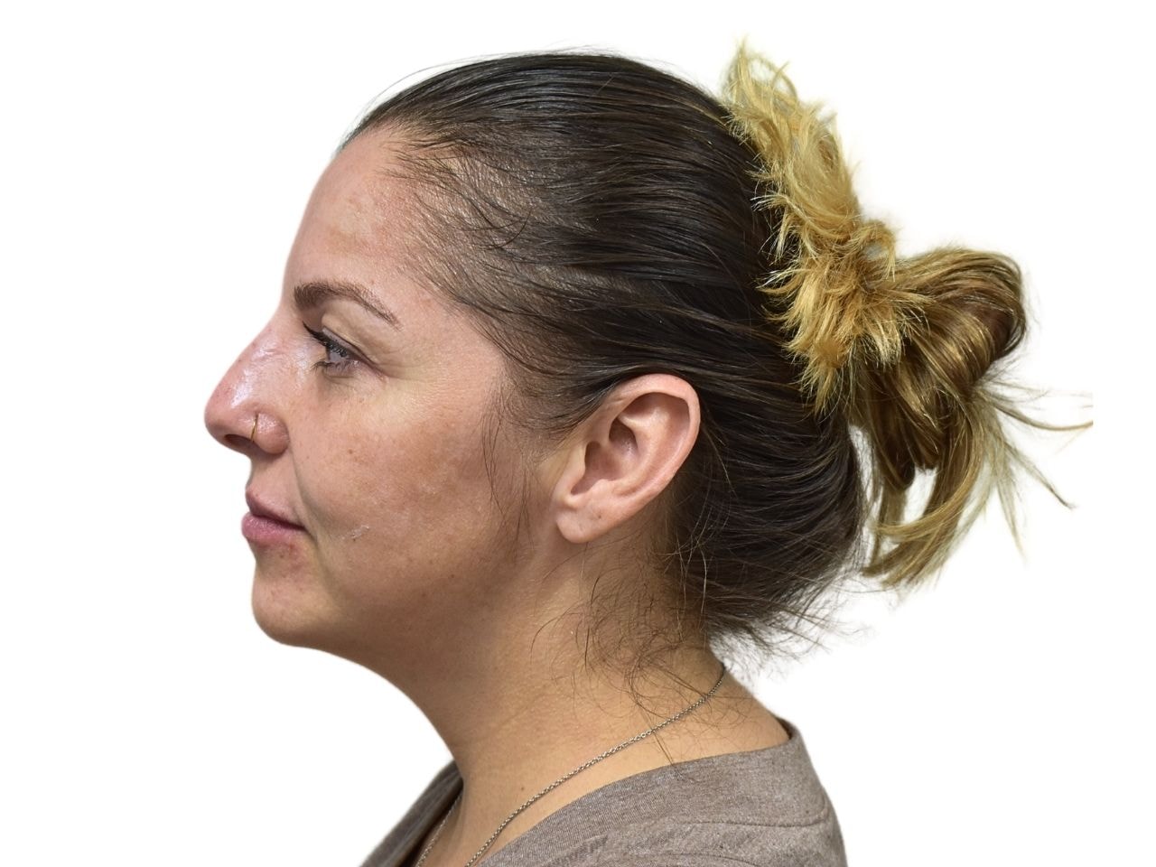 A result from Ava Bello Plastic Surgery
