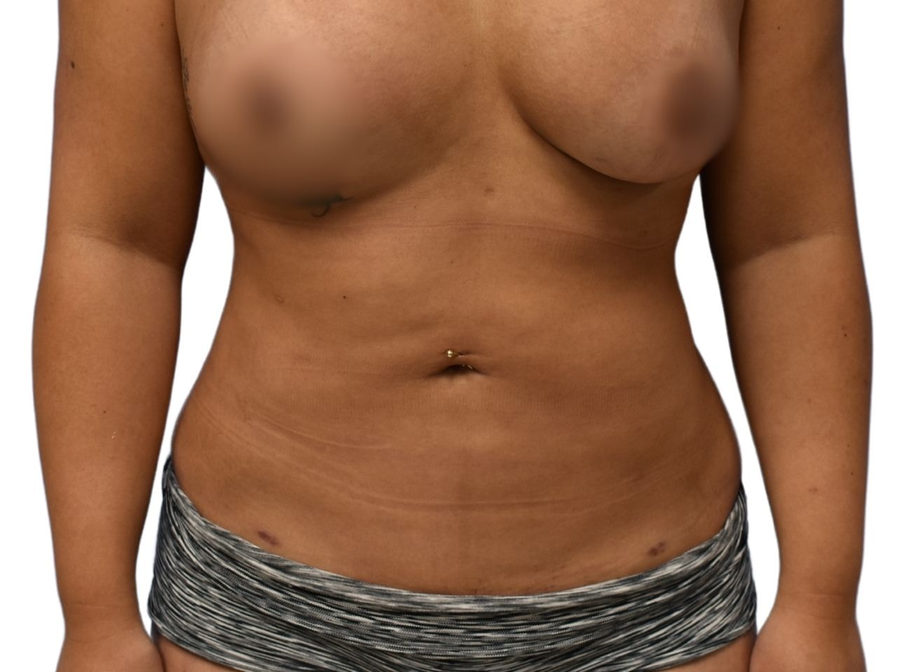 A result from Ava Bello Plastic Surgery