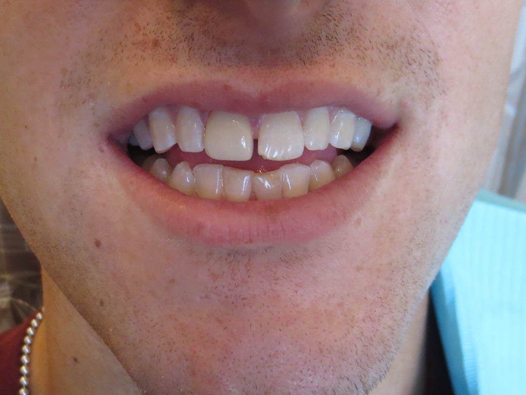 A result from Pacific Beach Smile Studio
