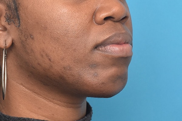 A result from Kirk Lozada, MD, Facial Plastic Surgery