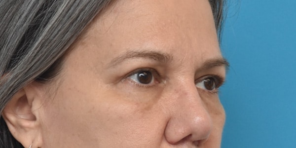A result from Kirk Lozada, MD, Facial Plastic Surgery