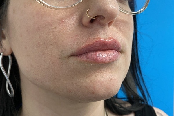 A result from Kirk Lozada, MD, Facial Plastic Surgery