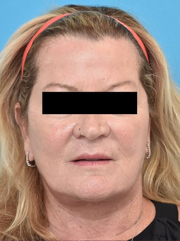 A result from Kirk Lozada, MD, Facial Plastic Surgery