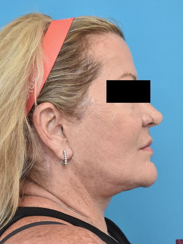 A result from Kirk Lozada, MD, Facial Plastic Surgery