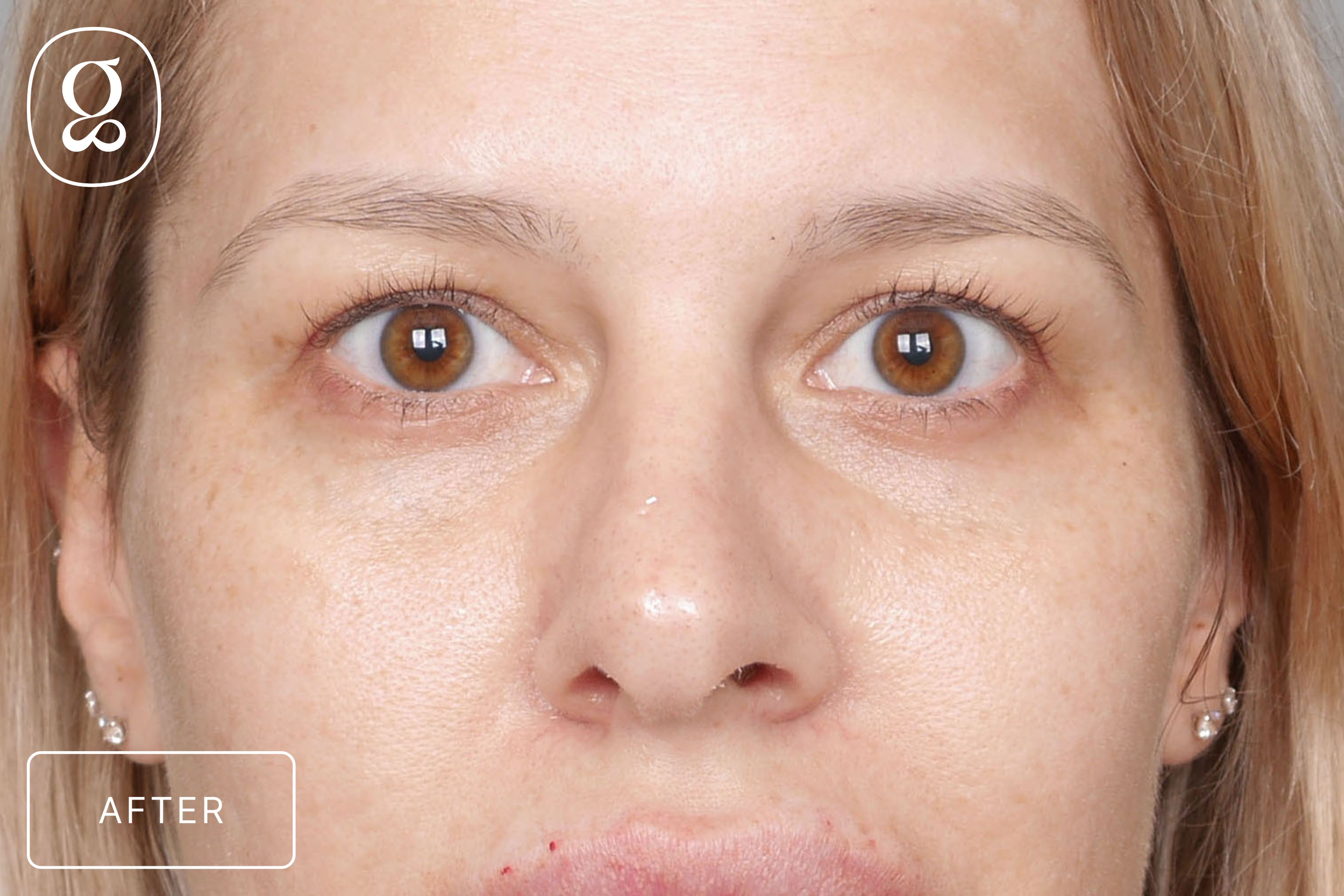 Blepharoplasty result at Gould Aesthetics