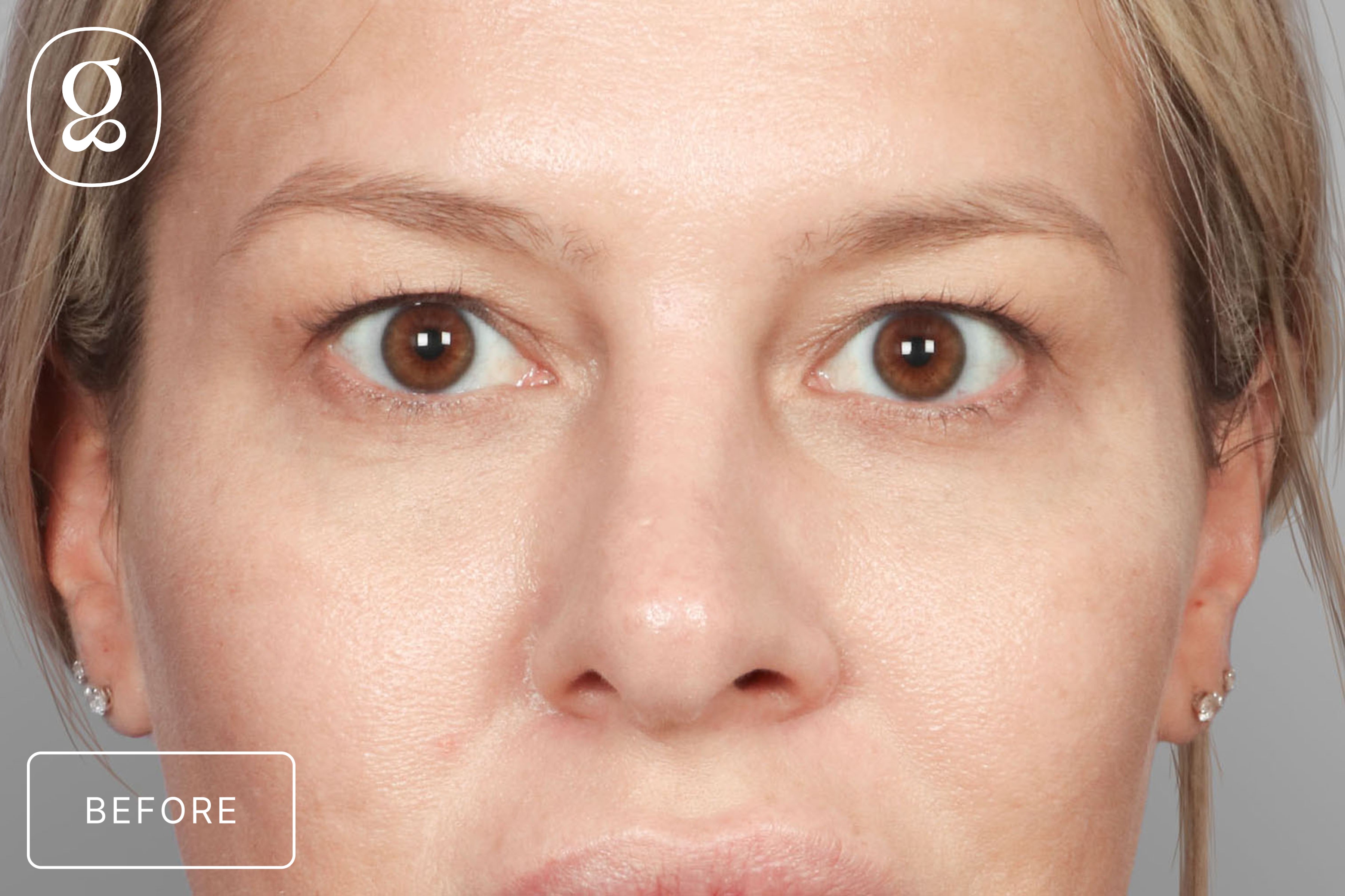 Blepharoplasty before photo