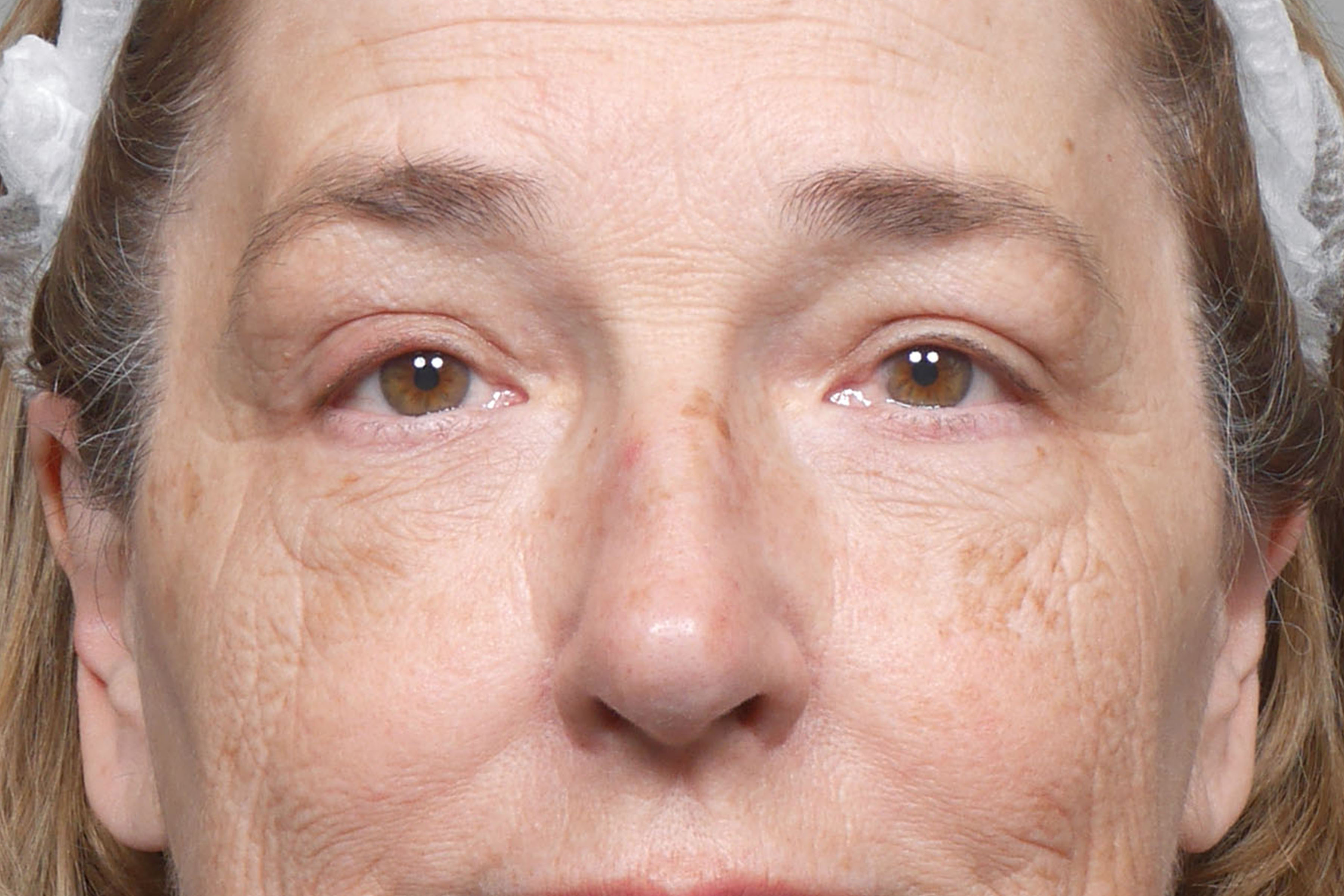 Blepharoplasty result at Gould Aesthetics