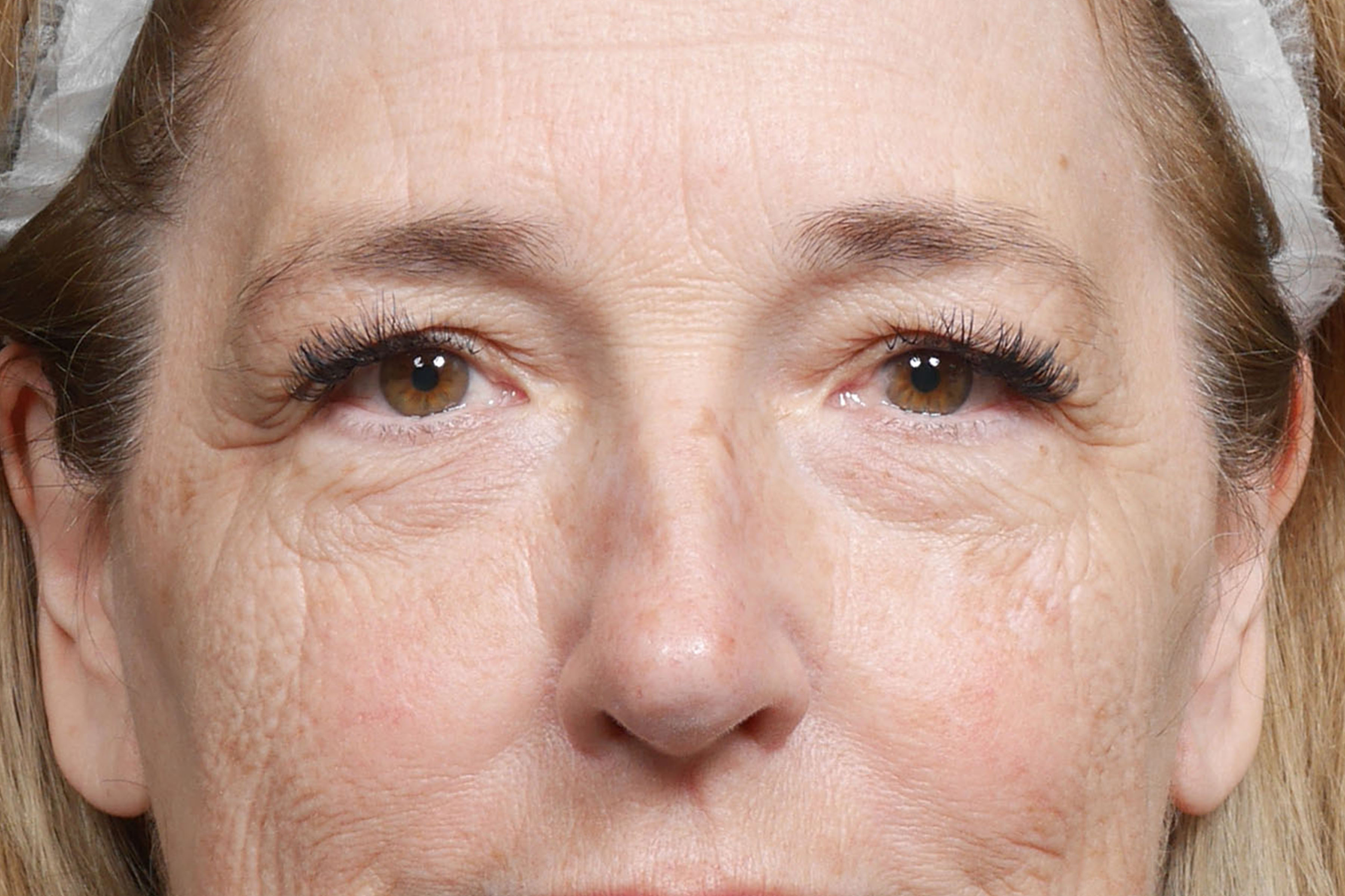 Blepharoplasty before photo