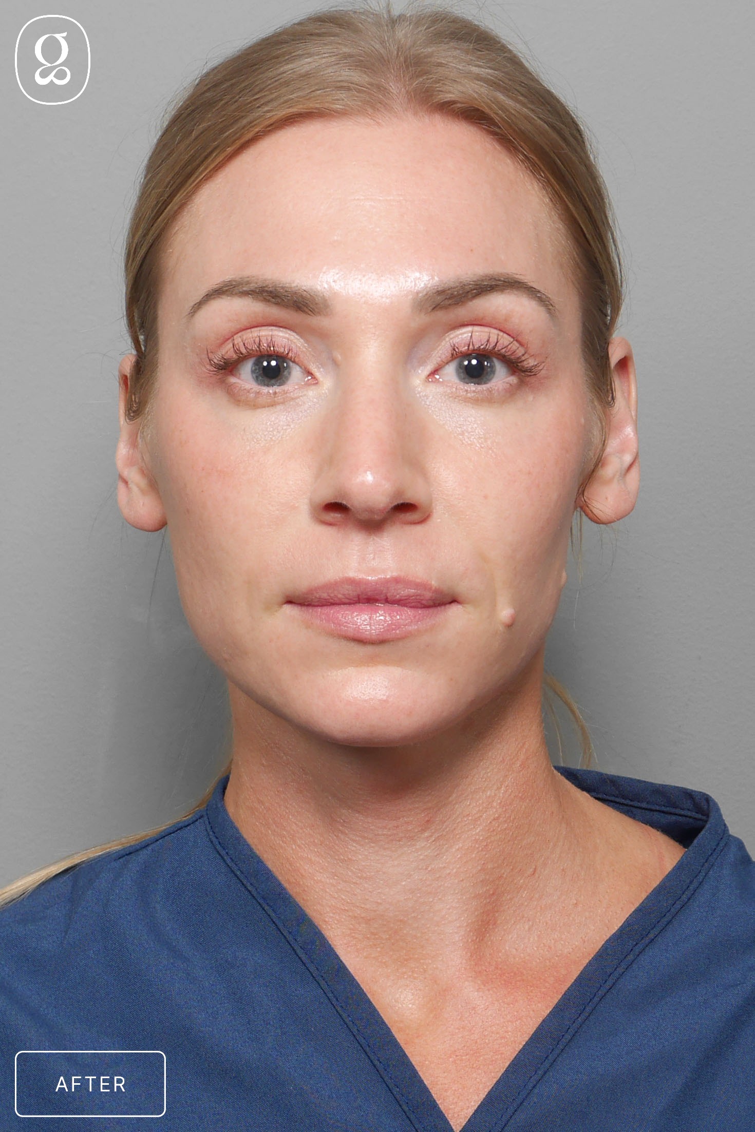 Facelift result at Gould Aesthetics