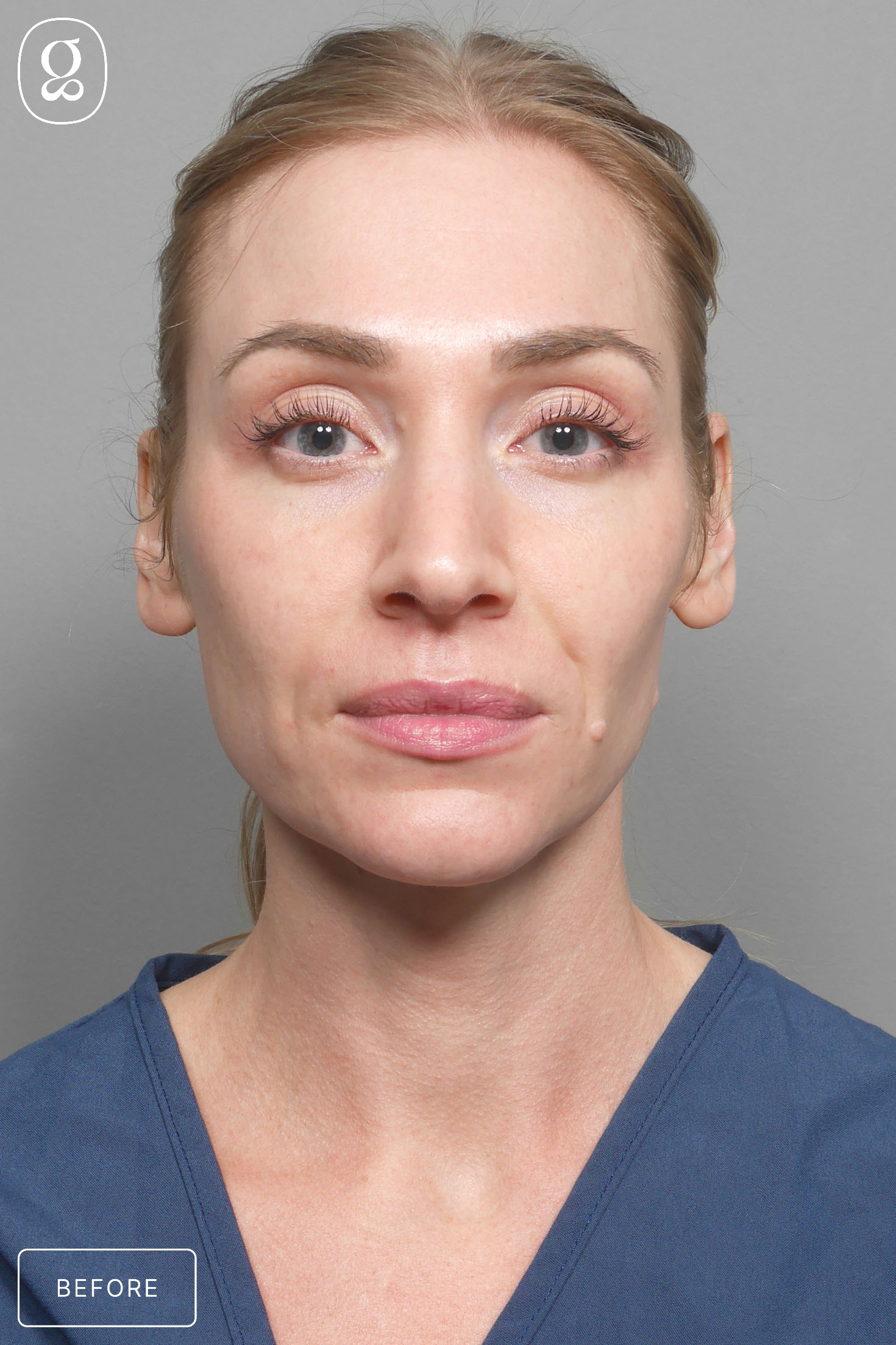 Facelift before photo