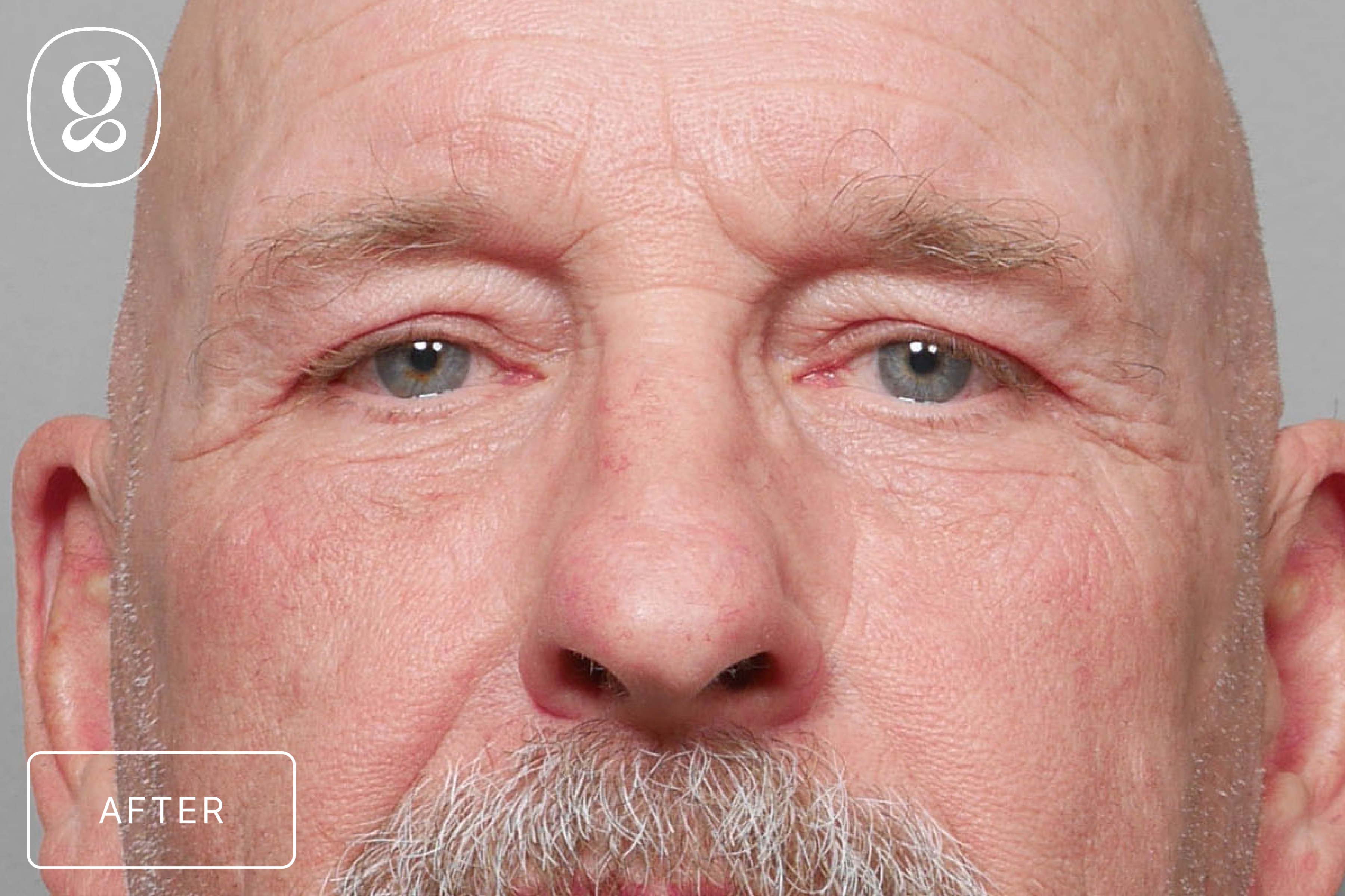 Blepharoplasty result at Gould Aesthetics