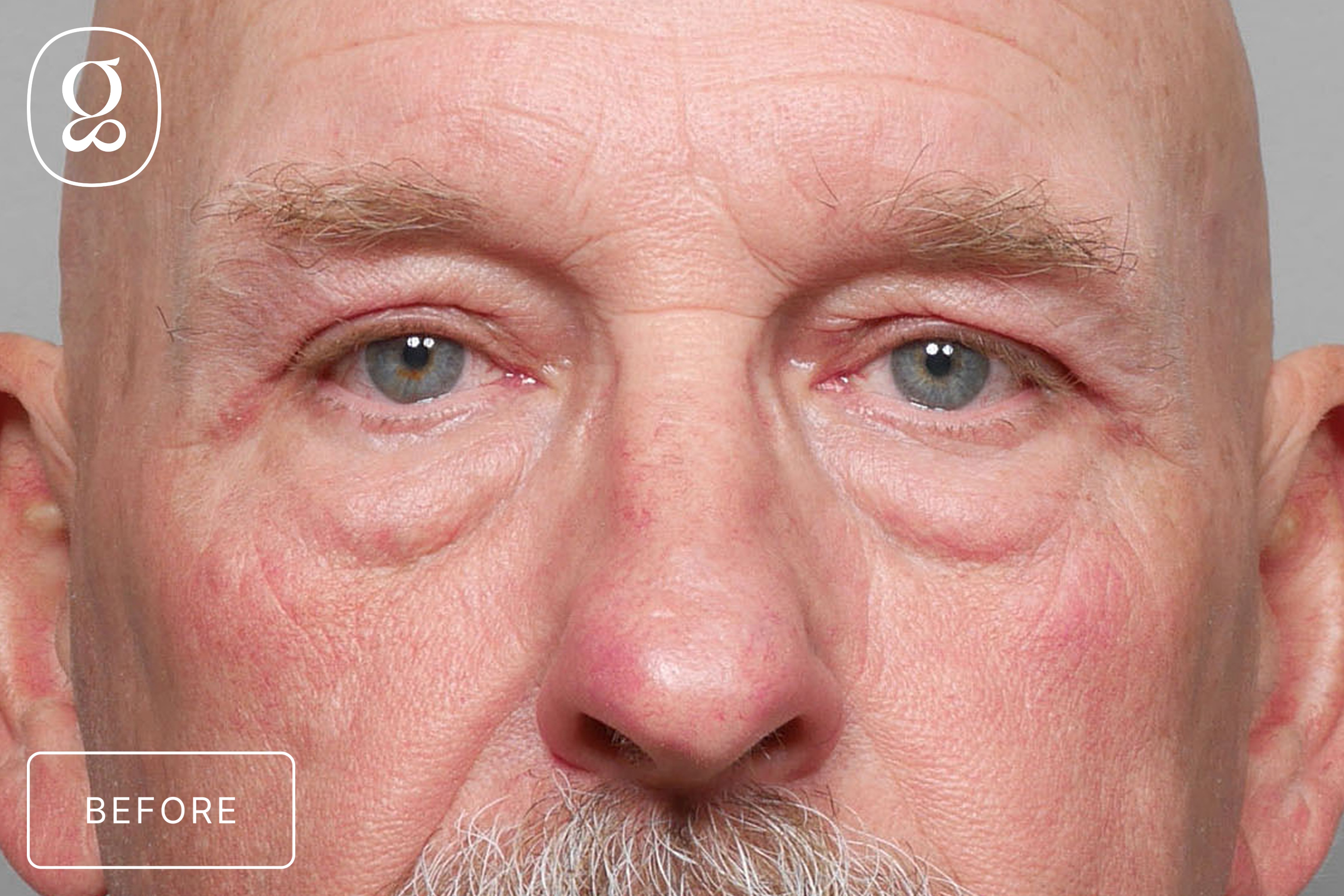 Blepharoplasty before photo