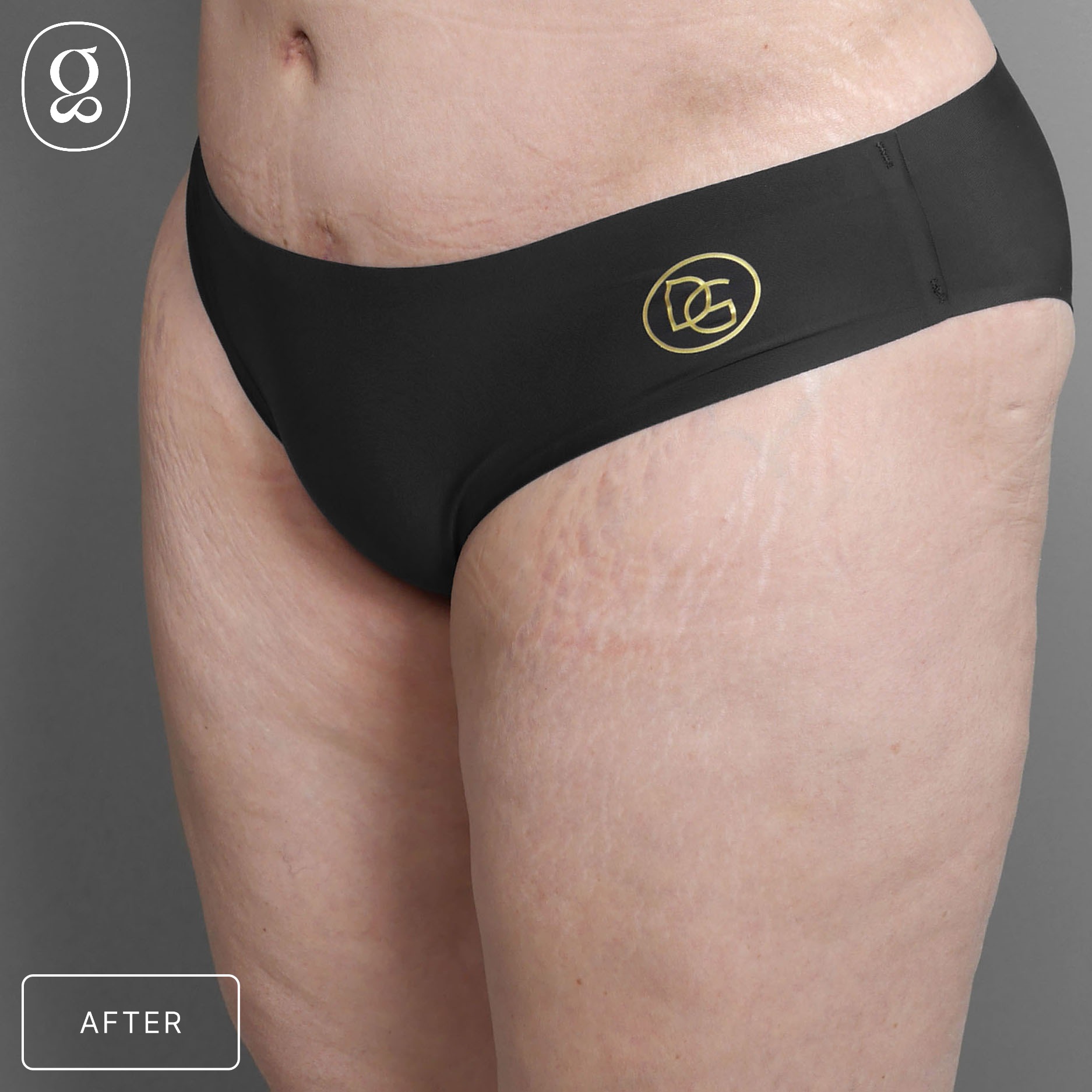 Body Contouring result at Gould Aesthetics